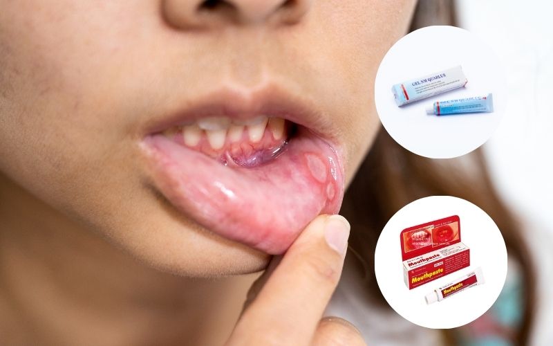 Top 10+ thuốc bôi nhiệt miệng hiệu quả được bác sĩ khuyến cáo